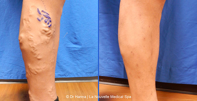 Varicose Vein Removal with Phlebectomy before after photos, Dr. Hanna La Nouvelle Medical Spa, Oxnard, Ventura County