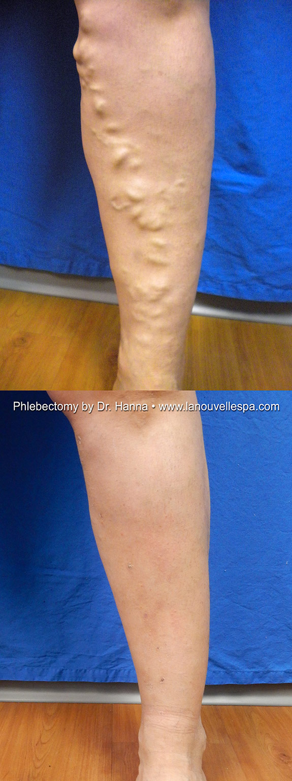 varicose vein removal by phlebectomy dr hanna ventura before ventura