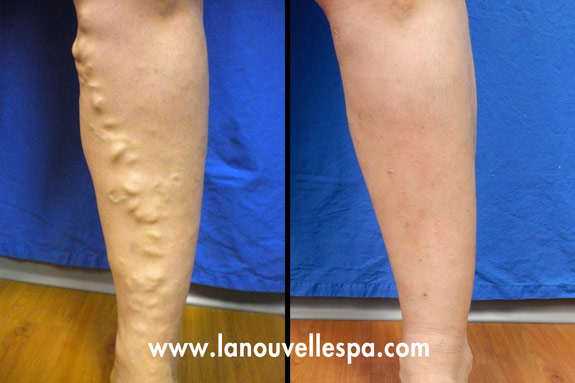varicose vein removal with phlebectomy by dr hanna oxnard, ventura