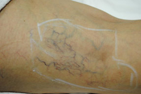 Varicose and Spider Vein Treatments - Before and After