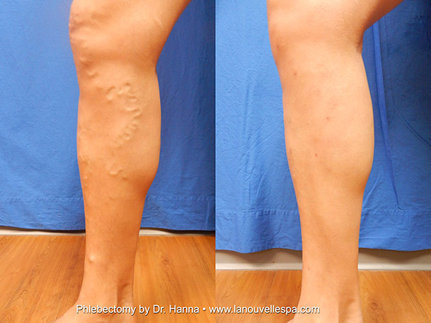 varicose vein removal by phlebectomy dr hanna ventura before ventura