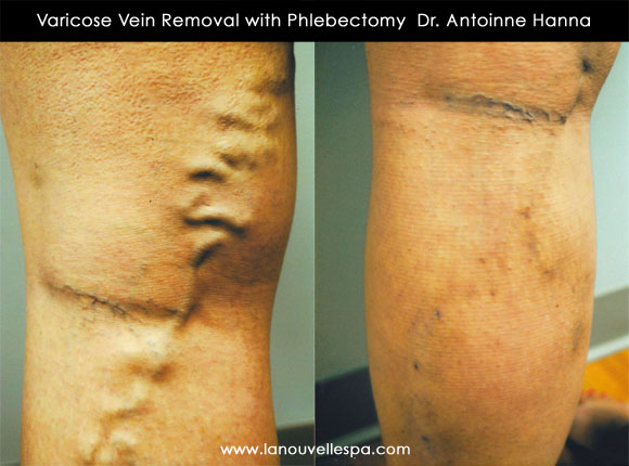 varicose vein removal by phlebectomy ventura dr hanna