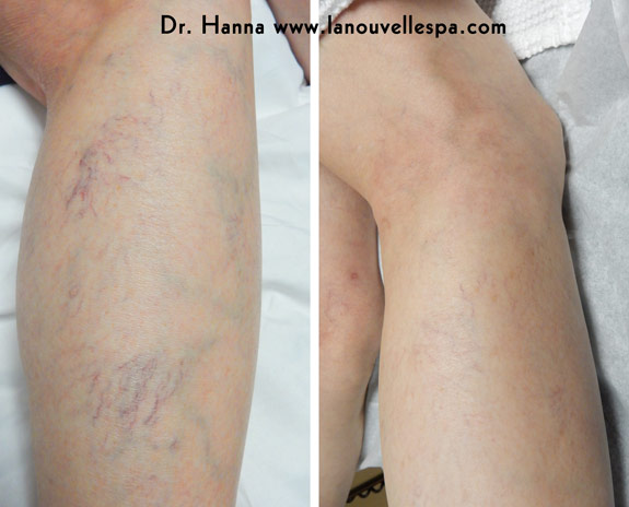 vein removal on ankle with asclera injections la nouvelle medical spa, oxnard, ventura