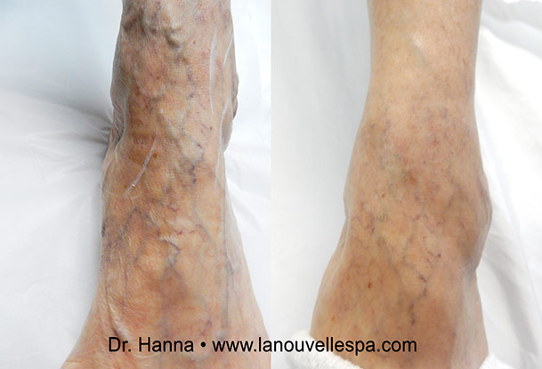vein removal on ankle with asclera injections la nouvelle medical spa, oxnard, ventura