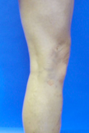 varicose vein removal by phlebectomy dr hanna ventura after