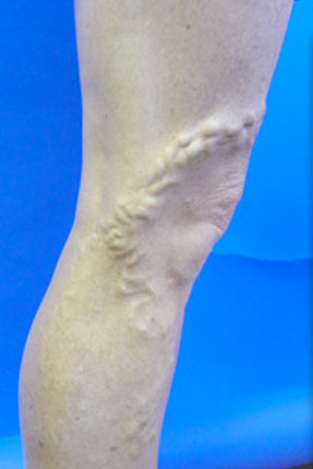 varicose vein removal by phlebectomy dr hanna ventura before