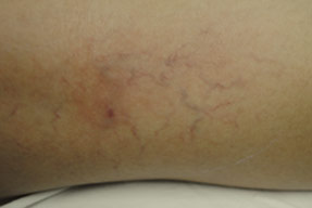 asclera injections for spider and varicose vein removal in oxnard, ventura county