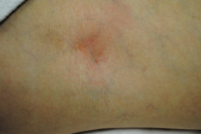vein Removal with asclera injections after photo, la nouvelle, oxnard