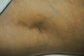 vein Removal with asclera injections before photo, la nouvelle, oxnard