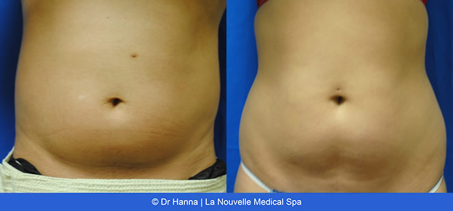 Vaser Shape non-invasive fat reduction before after photos, La Nouvelle Medical Spa, Oxnard, Ventura County