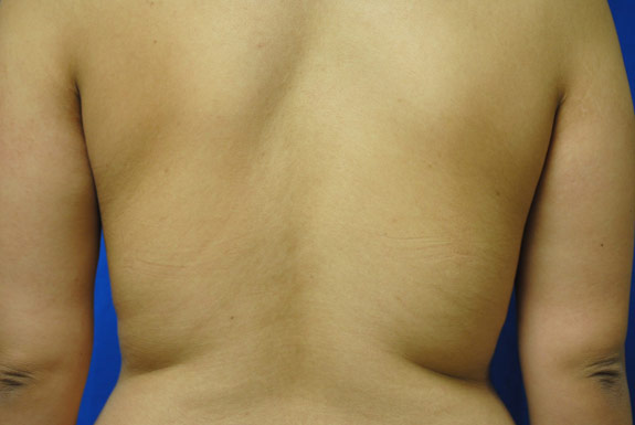 vaser shape on female back after photo