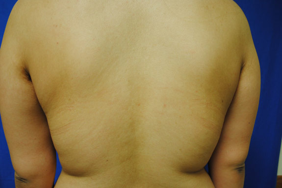 vaser shape on female back before photo