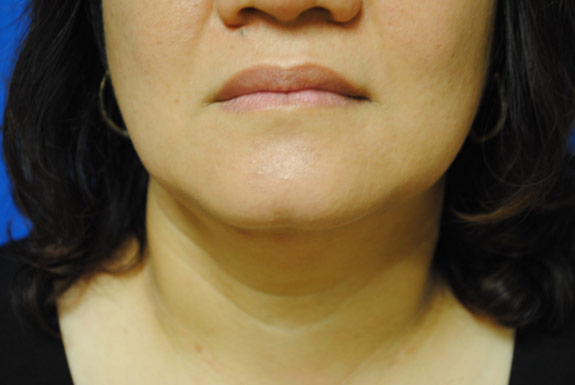 vaser shape  female neck area after photo