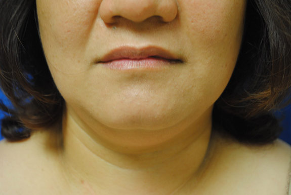 vaser shape female neck area before photo