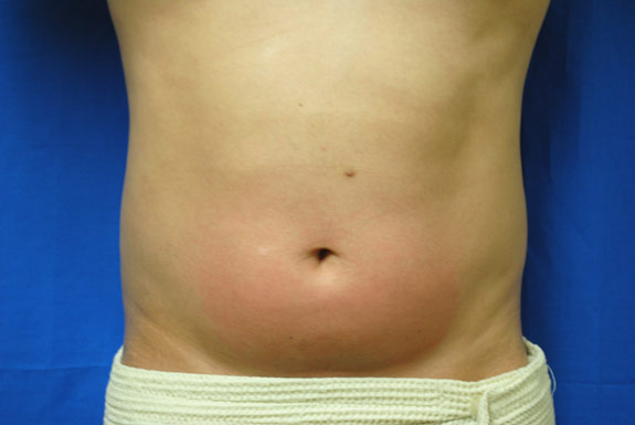 vaser shape on stomach after photo