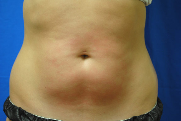 vaser shape on stomach after photo