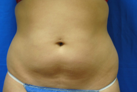 vaser shape on stomach before photo