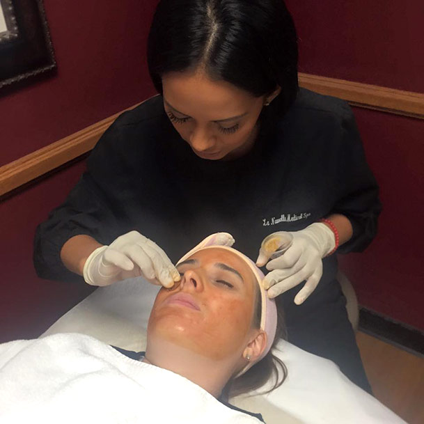 VI Peel treatment oxnard, ventura county