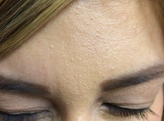 botox, dyspot, xeomin injections before after photos ventura oxnard