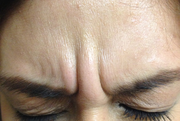 botox, dyspot, xeomin injections before after photos ventura oxnard