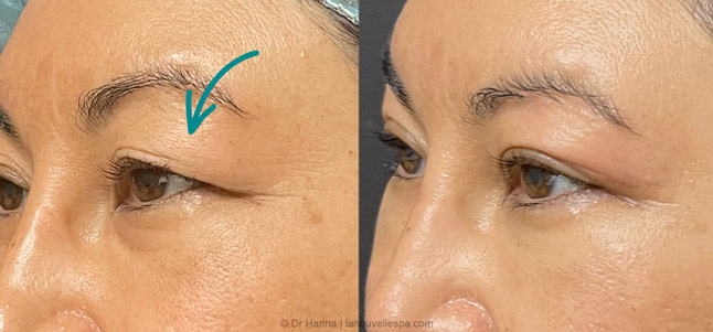 Asian Blepharoplasty upper Eyelid Surgery before after photos Ventura County, Dr. Hanna La Nouvelle Medical Spa, Oxnard