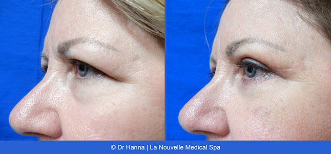 upper and lower Blepharoplasty Eyelid Surgery before after photos Ventura County, Dr. Hanna La Nouvelle Medical Spa, Oxnard