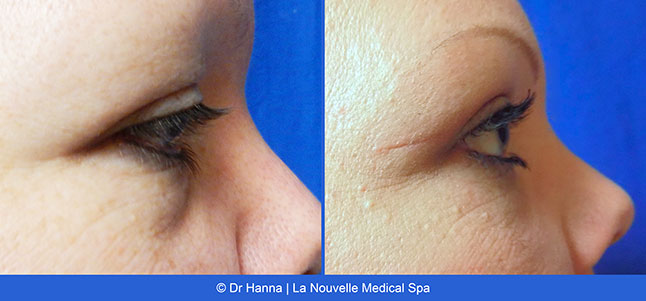 Blepharoplasty Eyelid Surgery before after photos Ventura County, Dr. Hanna La Nouvelle Medical Spa, Oxnard