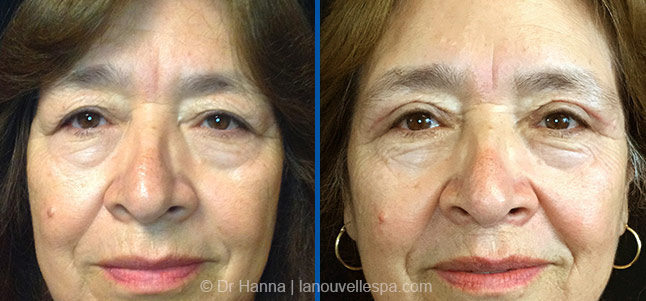 upper Blepharoplasty Eyelid Surgery before after photos Ventura County, Dr. Hanna La Nouvelle Medical Spa, Oxnard