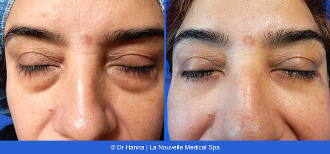 Blepharoplasty lower Eyelid Surgery before after photos Ventura County, Dr. Hanna La Nouvelle Medical Spa, Oxnard