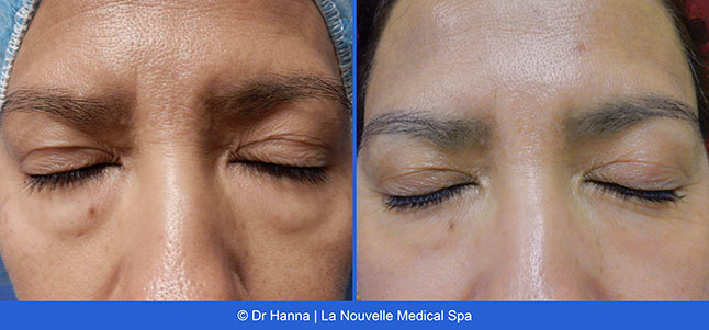 Blepharoplasty lower Eyelid Surgery before after photos Ventura County, Dr. Hanna La Nouvelle Medical Spa, Oxnard