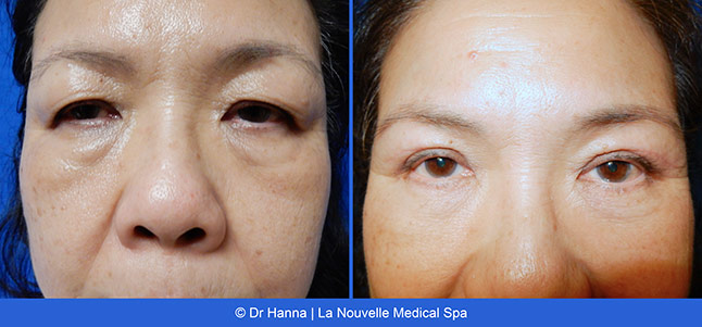 Blepharoplasty upper and lower Eyelid Surgery before after photos Ventura County, Dr. Hanna La Nouvelle Medical Spa, Oxnard