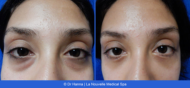 Blepharoplasty lower Eyelid Surgery before after photos Ventura County, Dr. Hanna La Nouvelle Medical Spa, Oxnard