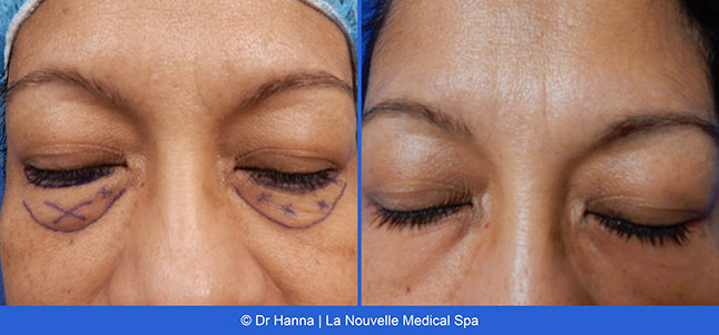 Blepharoplasty lower Eyelid Surgery before after photos Ventura County, Dr. Hanna La Nouvelle Medical Spa, Oxnard