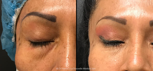 lower Blepharoplasty Eyelid Surgery before after photos front view, Ventura County, Dr. Hanna La Nouvelle Medical Spa, Oxnard