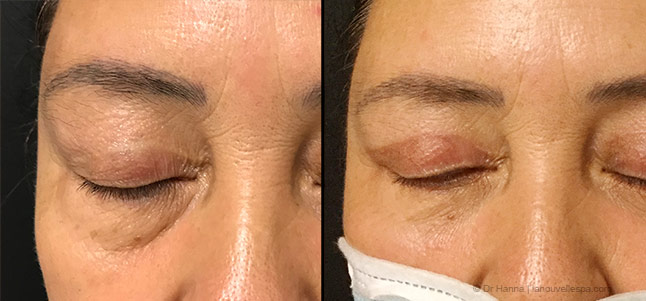 lower Blepharoplasty Eyelid Surgery before after photos Ventura County, Dr. Hanna La Nouvelle Medical Spa, Oxnard