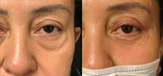 lower Blepharoplasty Eyelid Surgery before after photos Ventura County, Dr. Hanna La Nouvelle Medical Spa, Oxnard