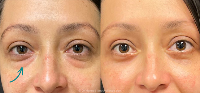lower Blepharoplasty Eyelid Surgery before after photos Ventura County by dr. Hanna, La Nouvelle Medical Spa, Oxnard