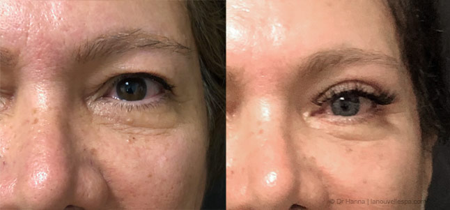 upper Blepharoplasty Eyelid Surgery before after photos Ventura County by dr. Hanna, La Nouvelle Medical Spa, Oxnard