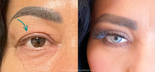 upper Blepharoplasty Eyelid Surgery before after photos Ventura County by dr. Hanna, La Nouvelle Medical Spa, Oxnard