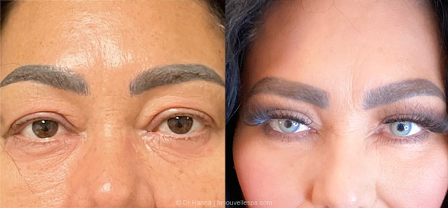 upper Blepharoplasty Eyelid Surgery before after photos Ventura County by dr. Hanna, La Nouvelle Medical Spa, Oxnard