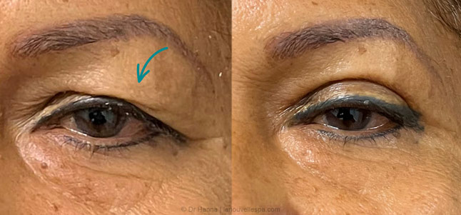 upper Blepharoplasty Eyelid Surgery before after photos Ventura County by dr. Hanna, La Nouvelle Medical Spa, Oxnard