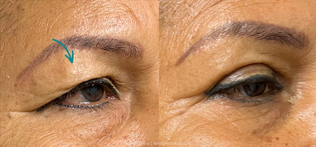 upper Blepharoplasty Eyelid Surgery before after photos Ventura County by dr. Hanna, La Nouvelle Medical Spa, Oxnard