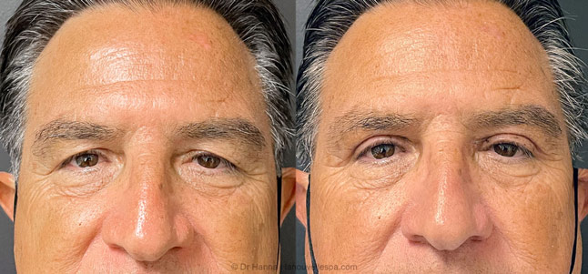 upper Blepharoplasty Eyelid Surgery before after photos Ventura County by dr. Hanna, La Nouvelle Medical Spa, Oxnard