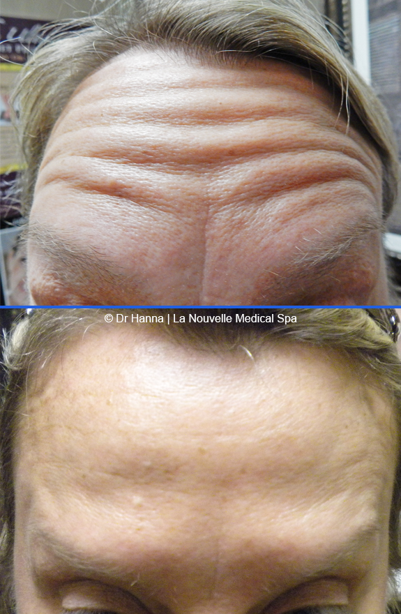 botox, dyspot, xeomin injections before after photos ventura oxnard