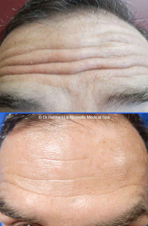 botox, dyspot, xeomin injections before after photos ventura oxnard
