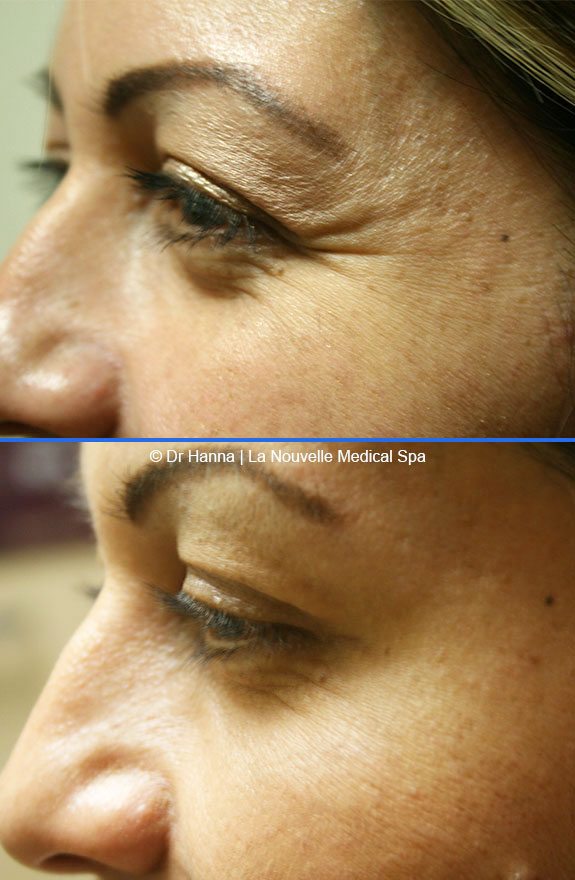 botox, dyspot, xeomin injections before after photos ventura oxnard