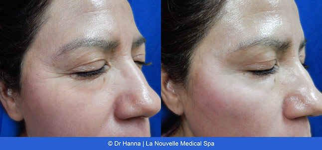 Botox, Xeomin before after photos Ventura County, La Nouvelle Medical Spa, Oxnard, Dr. Antoine Hanna, Dr. Jack Shenouda 