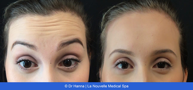 Botox, Xeomin before after photos Ventura County, La Nouvelle Medical Spa, Oxnard, Dr. Antoine Hanna, Dr. Jack Shenouda 