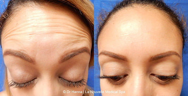 Botox, Xeomin before after photos Ventura County, La Nouvelle Medical Spa, Oxnard, Dr. Antoine Hanna, Dr. Jack Shenouda 