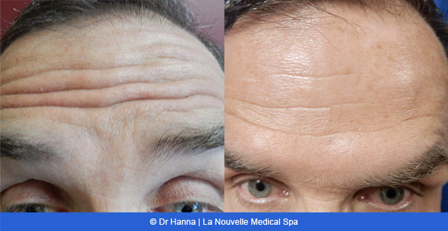 Botox, Xeomin before after photos Ventura County, La Nouvelle Medical Spa, Oxnard, Dr. Antoine Hanna, Dr. Jack Shenouda 